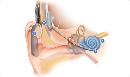 První kochleární implantace dítěte na Moravě I