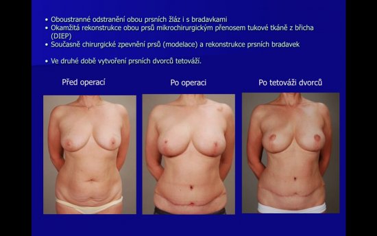 Dvě v jedné aneb preventivní odstranění vaječníků i prsních žláz