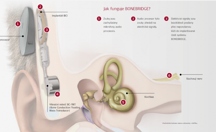 sluchovy implantat