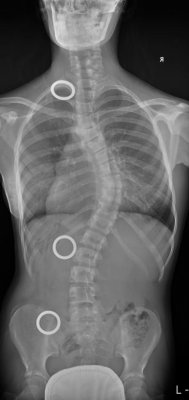 Od zdravé páteře skoro k nerozeznání_před