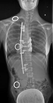 Od zdravé páteře skoro k nerozeznání_po