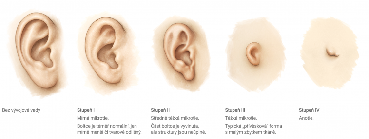 Mikrotie - klasifikace