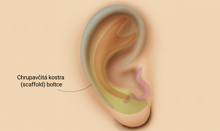Mikrotie léčba - Rekonstrukce boltce chrupavčitým štěpem