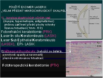 Princip funkce excimer laseru II.JPG